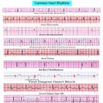 Ekg Practice Worksheets With Answers