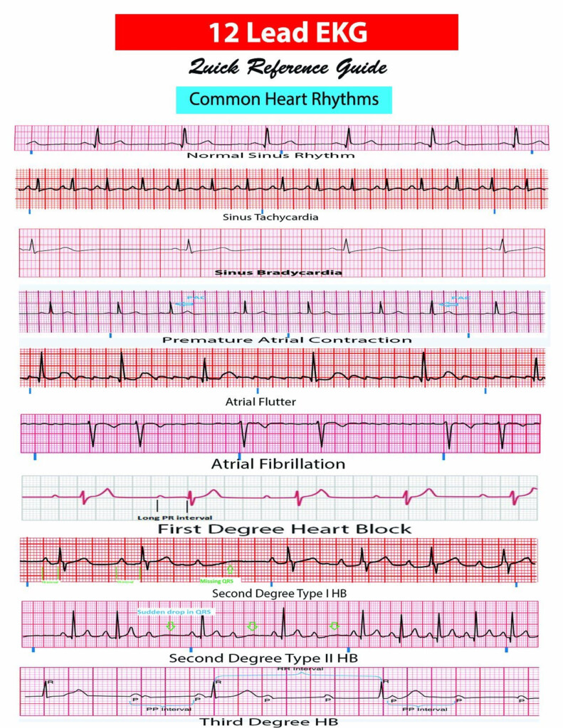 Ekg Practice Worksheets With Answers